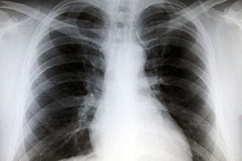 x-ray of lungs